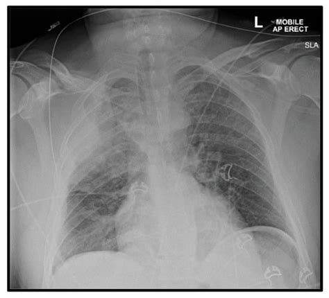 Reports Free Full Text Cpr Induced Life Threatening Hemothorax In A