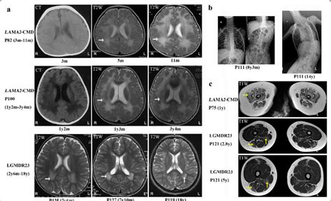 The Image Features In Patients With Lama2 Related Muscular Dystrophy A