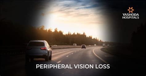 Peripheral Vision Loss Causes Diagnosis Prevention And Treatment