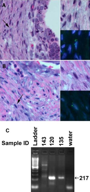 Xmrv Infection In Patients With Prostate Cancer Novel Serologic Assay