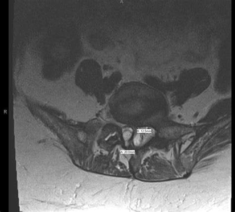 Lumbar Laminectomy For Synovial Cyst