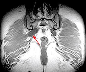 Ct Pelvis Anatomy Muscles Piriformis Syndrome Radsource Ct Series