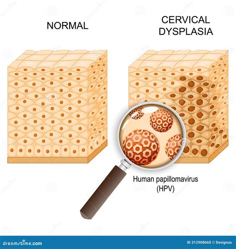 Cervical Dysplasia And Human Papillomavirus Infection Vector