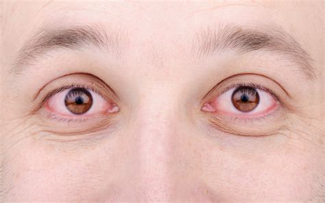 Conjuntivitis Alérgica Causas Síntomas Y Tratamiento La Guía De Las