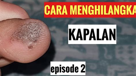 Cara Menghilangkan Kapalan Project Hari Kedua 2 With Callusol Youtube