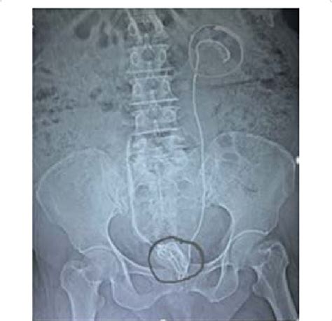 Retained stent with encrustations on over its upper end. Bilateral DJ... | Download Scientific ...