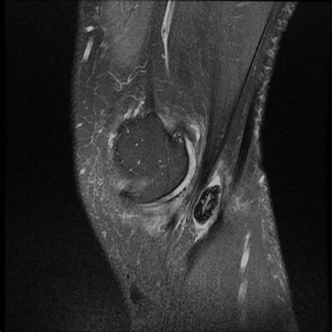 Posterior loose body. Source: CKC UK. www.kneeclinic.info | Knee mri, Mri