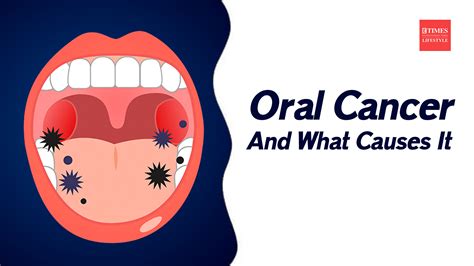 Oral Cancer And What Causes It Lifestyle Times Of India Videos