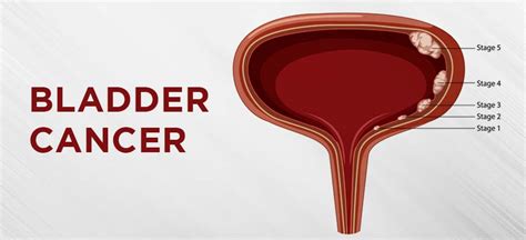 Bladder Cancer Causes Symptoms And Treatment Ah