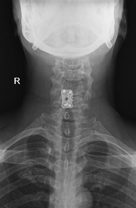 Anterior Cervical Discectomy And Fusion Acdf Image