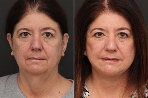 Facelift Before And After Photos Nicole Schrader Md Facs