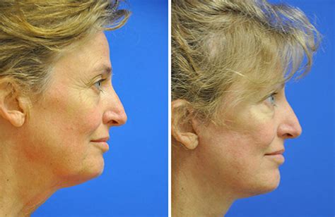 Facelift Austin Tx Dr Weinfeld