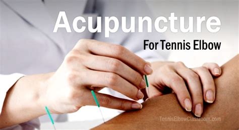 Can Acupuncture Help Your Tennis Elbow Heal