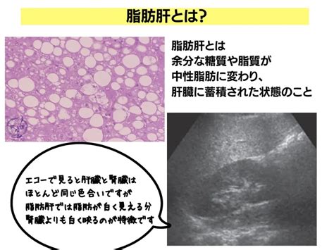 脂肪肝の原因と薬物治療による改善方法について解説 ひまわり医院（内科・皮膚科）