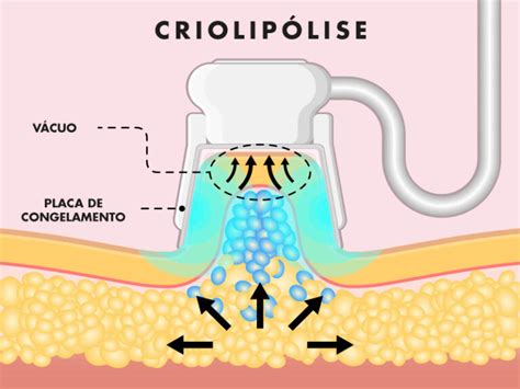 Como Funciona A Criolipólise - Criolipólise funciona? Veja tipos, valor da sessão e resultados
