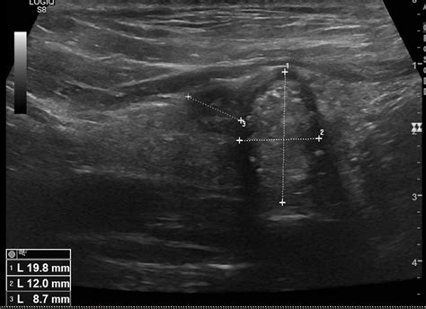 Classification Eu Tirads Toulouse Thyroide