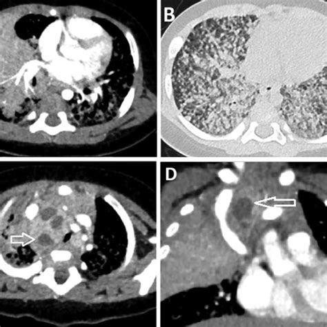 Miliary Brain Tuberculosis In A Year Old Female With Month History