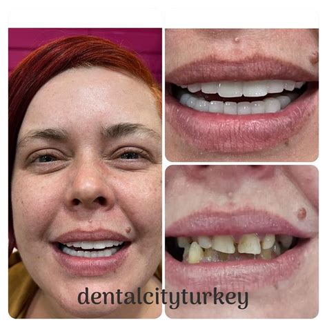 Before And After Veneers Turkey Dental City Turkey