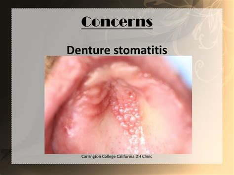 Ppt Denture Stomatitis Powerpoint Presentation Id 2034905