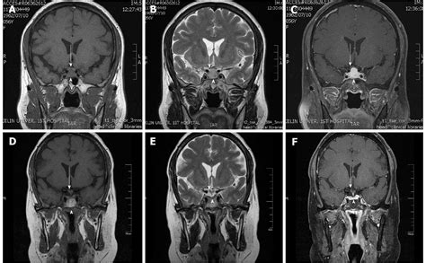 Enlarged Pituitary Gland Mri