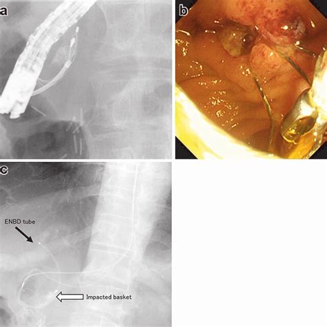 A ERCP Showing A Stone And An Impacted Basket In The Common Bile