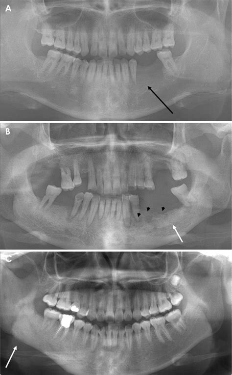 Osteomyelitis Jaw Radiographic Appearance