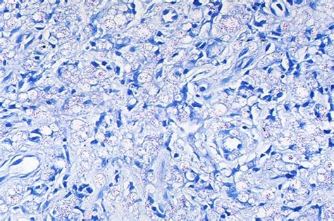 Pathology Outlines Acid Fast Auramine Rhodamine