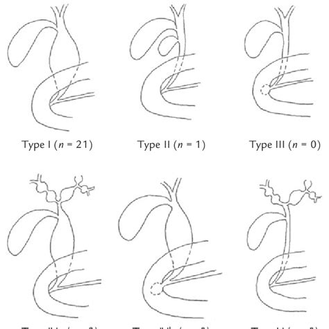 Figure Types Of Choledochal Cysts In The 25 Patients According To Download Scientific Diagram