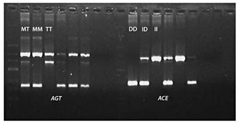 AGT 235 MT and ACE I/D gene polymorphism analysis in IVA patients ... 