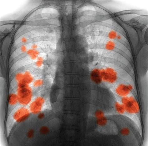 Secondary Lung Cancer Photograph By Science Photo Library Fine Art