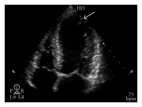 (a) Regional wall-motion abnormality confirmed by transthoracic... | Download Scientific Diagram