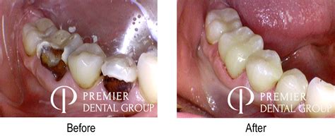 Before & After Photos - Premier Dental Group