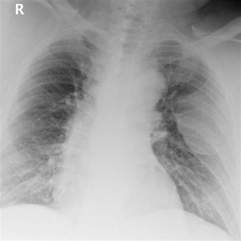 Anteroposterior Portable Chest Radiograph Shows A 9 Cm Rounded Opacity