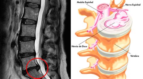 H Rnia De Disco Lombar Dr Michel Kanas