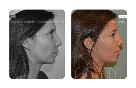 Rinoplastia Cerrada · Caso 12 Cirugía Estética Madrid · Clínica Femm