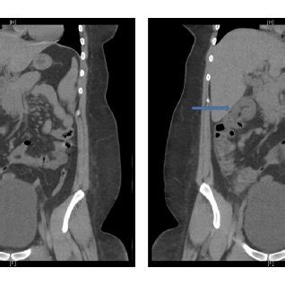 Ct Abdomen Demonstrating Colocolic Intussusception At The Hepatic