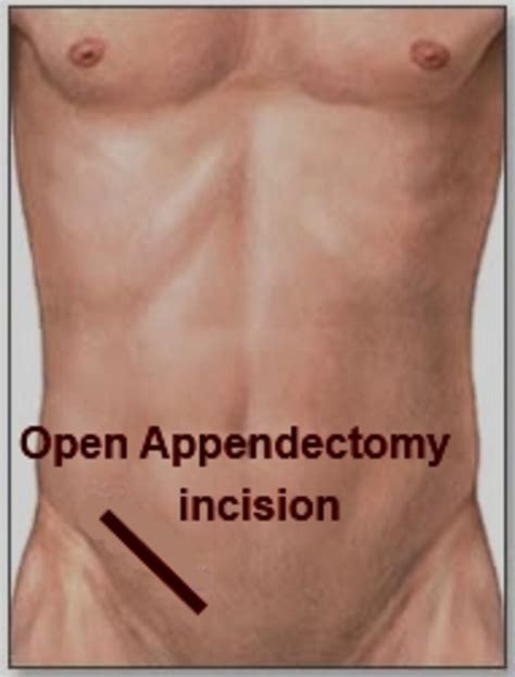 Symptoms Of Appendicitis And Ruptured Appendix Know What To Look