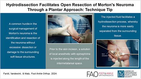 Hydrodissection Facilitates Open Resection Of Morton’s Neuroma Through A Plantar Approach