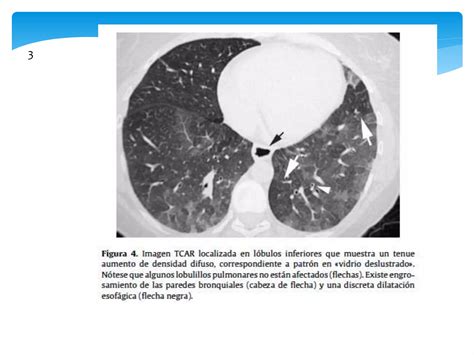 Enfermedad Pulmonar Intersticiales Difusas Ppt