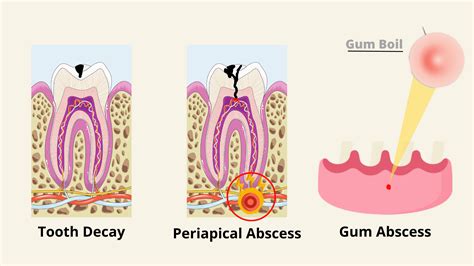 The Stages Of A Gum Abscess And Its Healing Process