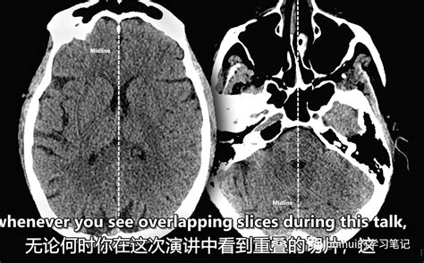 颅脑影像学读片教程CT MRI MedSci cn