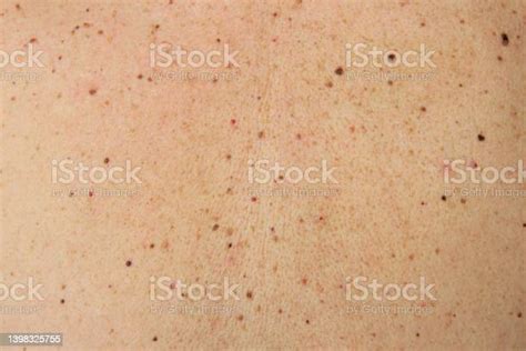 Moles And Birthmark On Human Skin Stock Photo Download Image Now