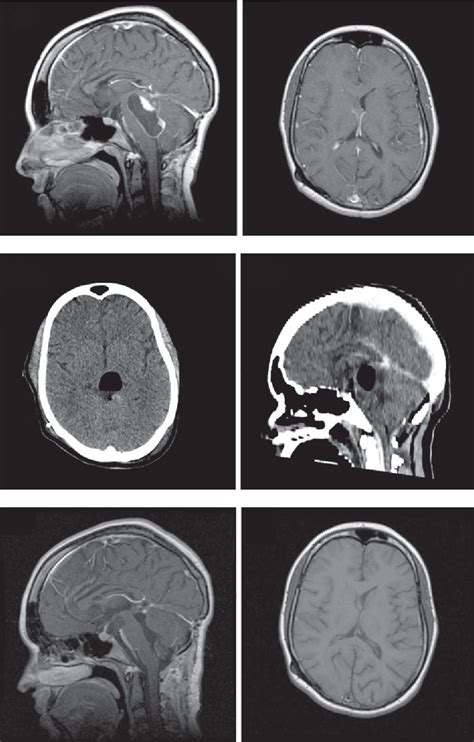 Figure From Postoperative Brain Stem Tension Pneumocephalus Causing