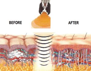 Acoustic Wave Therapy Las Vegas NV | A Touch Above Chiropractic