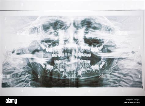 Dental X Ray Of The Babys Milk And Molars Two Rows Of Teeth Change