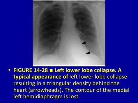 Pulmonary Lobar Collapse Essential Considerations 14 Dr Muhammad Bi