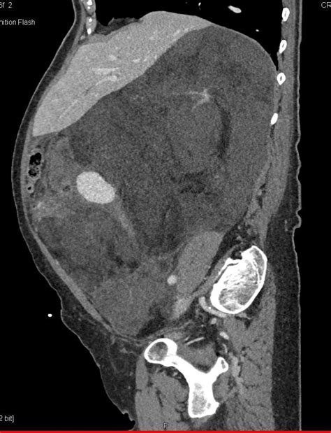 Retroperitoneal Liposarcoma Musculoskeletal Case Studies Ctisus Ct