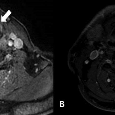 A Preoperative Magnetic Resonance Imaging MRI Findings Mass Lesion