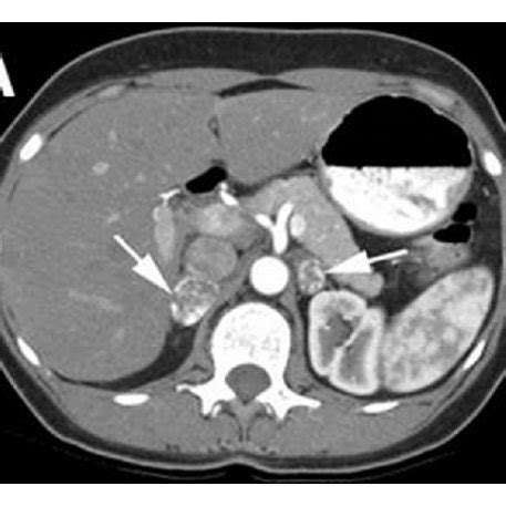 Clinical Features of MEN2B syndrome. Note (a) the laxity in the first ...