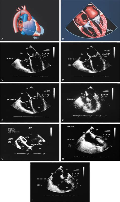 Normal Anatomy Atlas Of Transesophageal Echocardiography Nd Edition